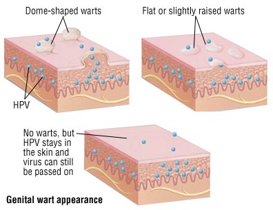 What Are Genital Warts?